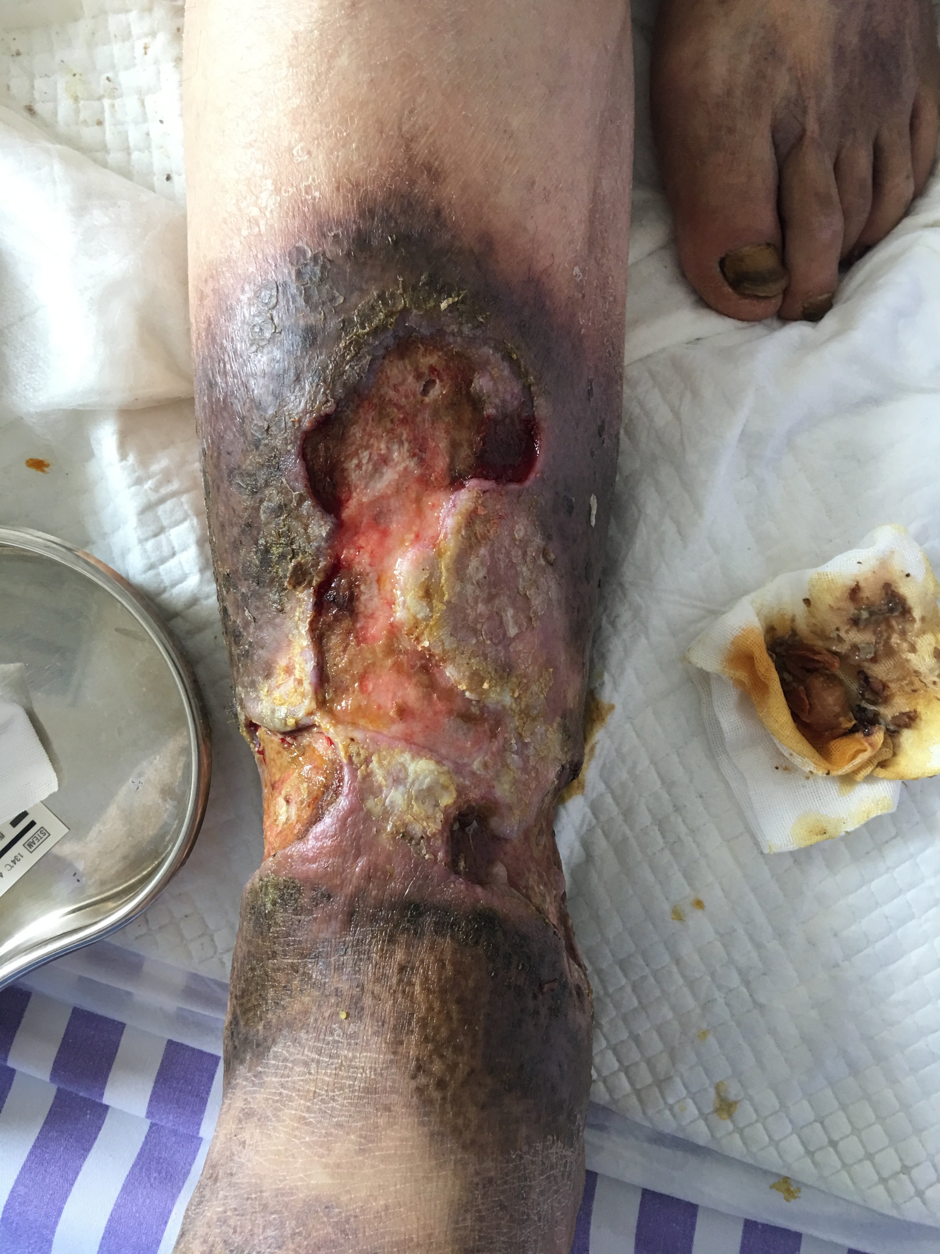 老烂腿静脉性溃疡