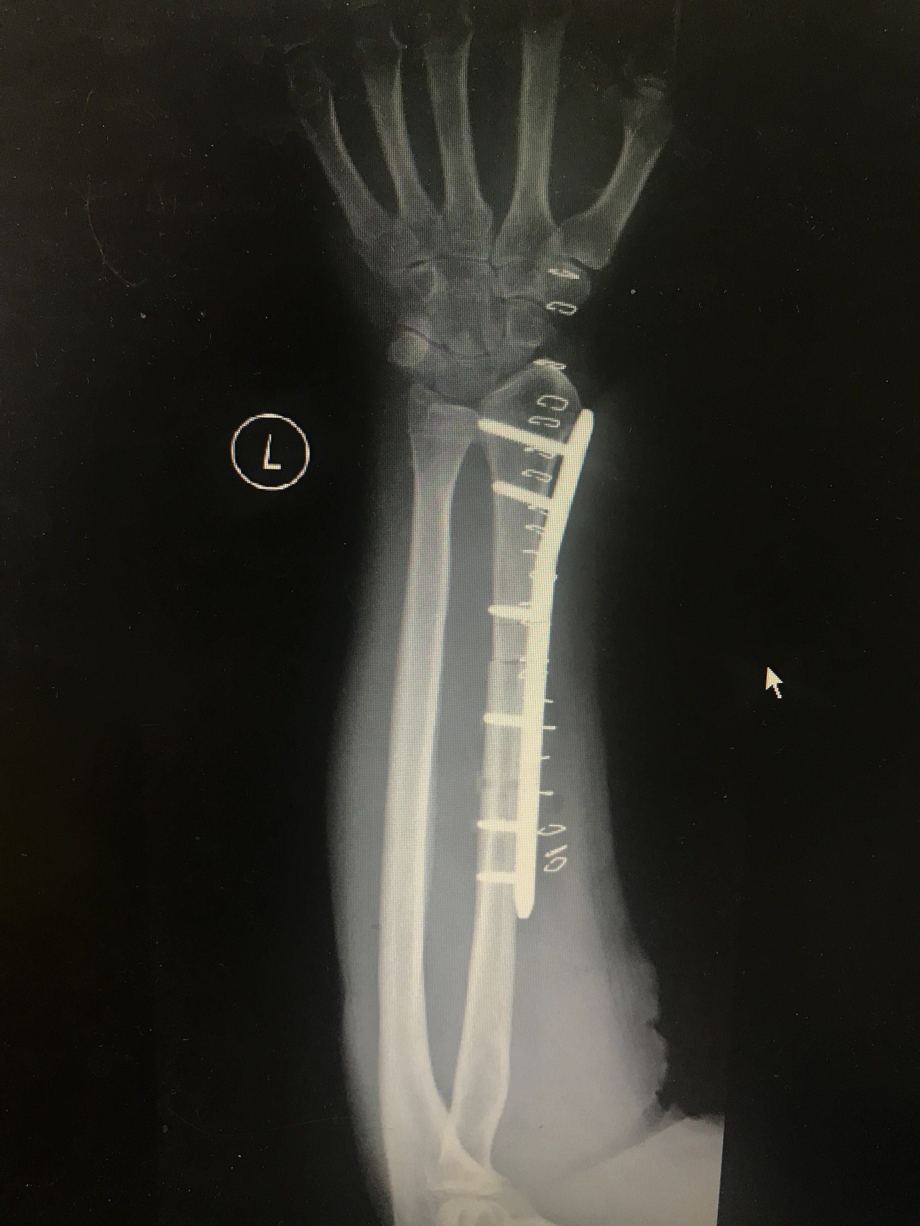 桡骨远端骨肉瘤,切除肿瘤,应用同侧腓骨替代