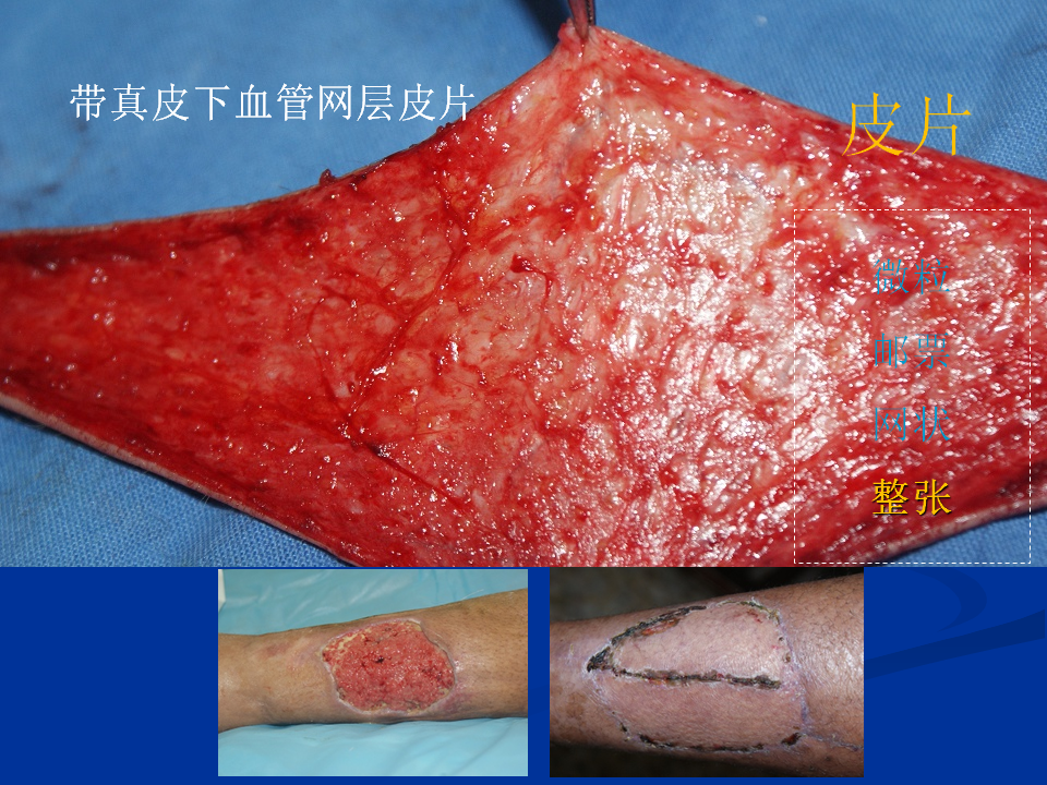皮肤移植基本概念 - 好大夫在线