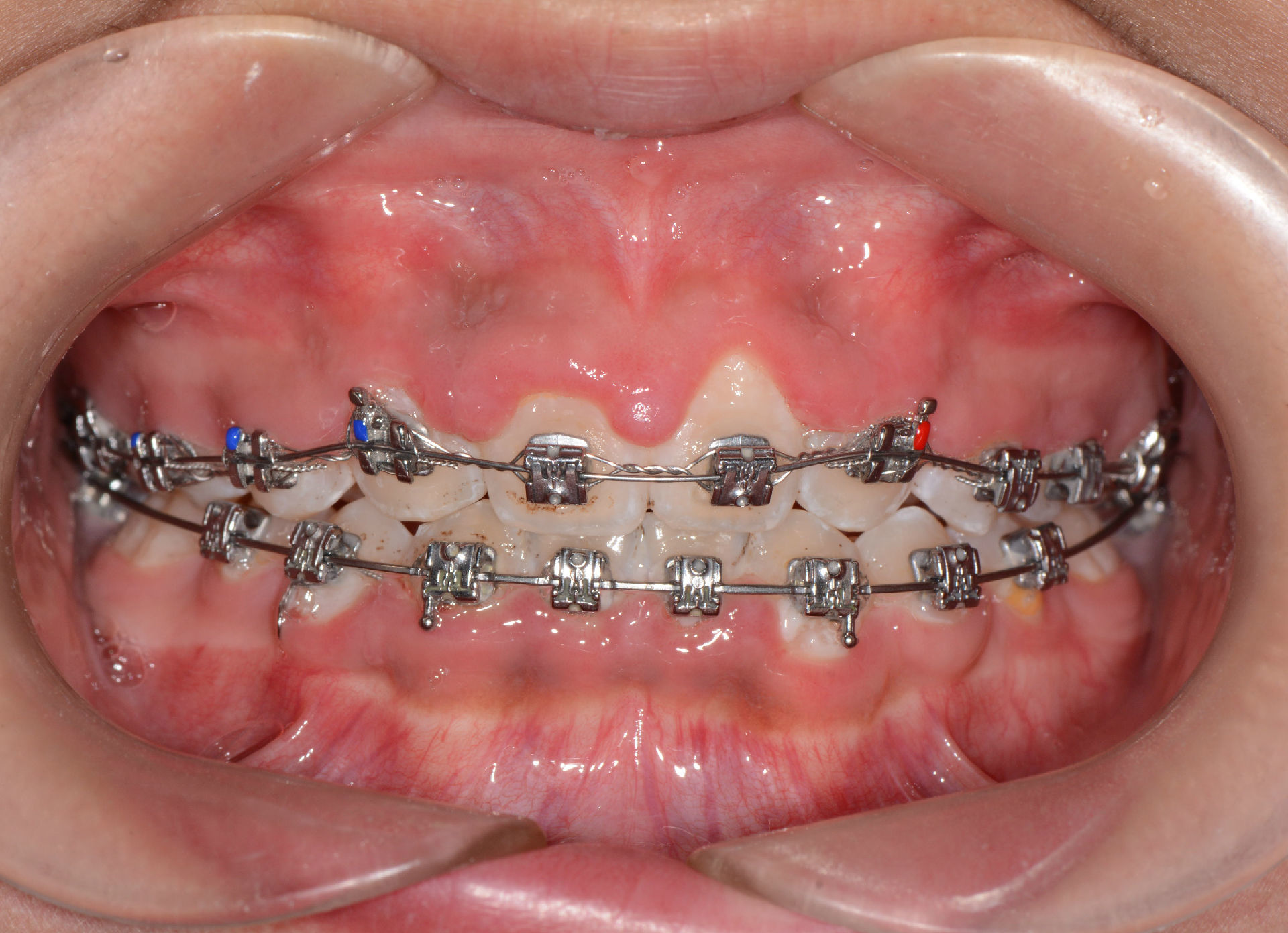 由于口腔卫生控制不好而导致 牙龈发炎 增生的患者