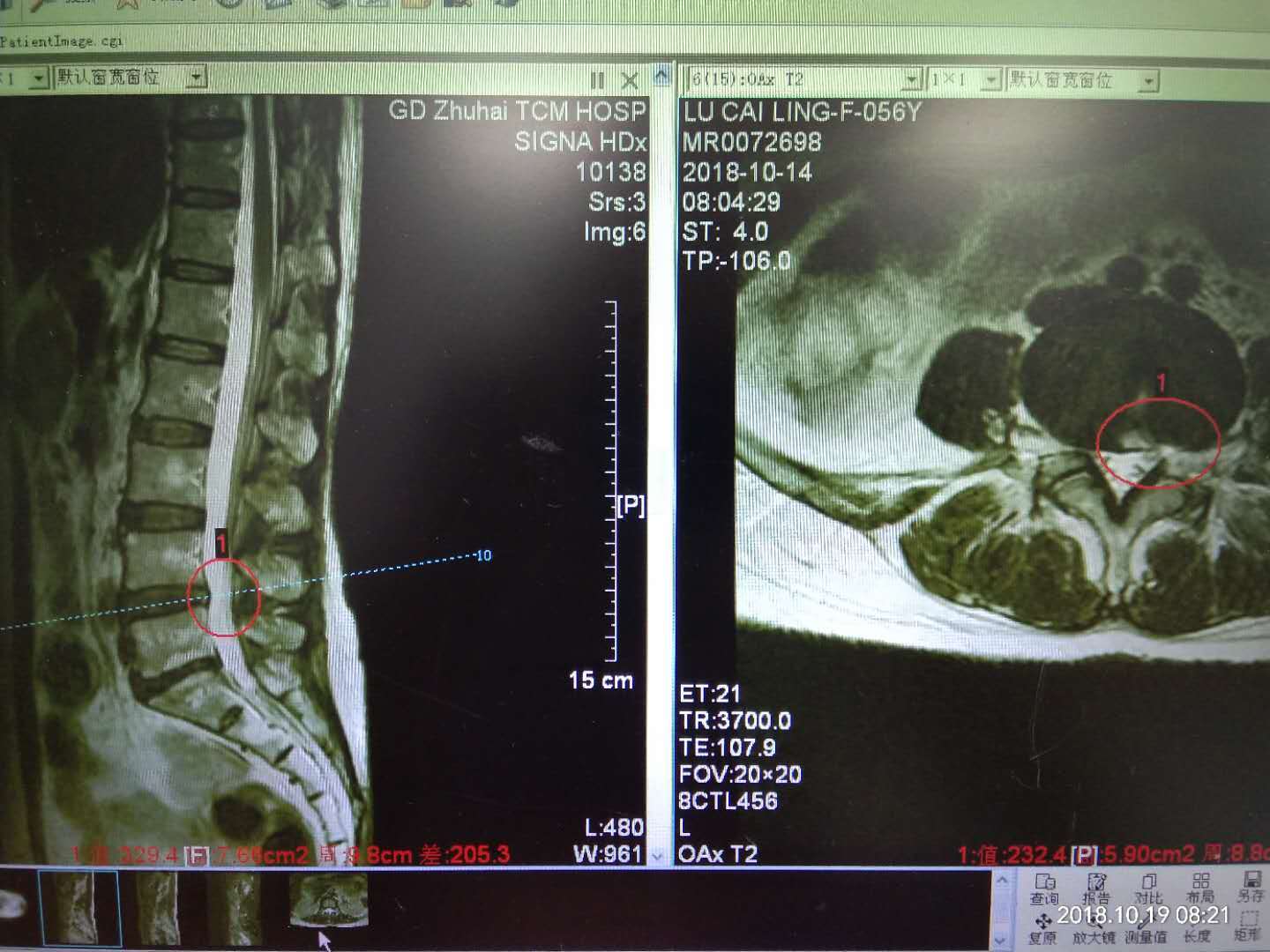 術前磁共振可見到左側腰4/5椎間盤突出並側隱窩狹窄