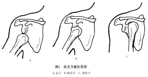 什么是骨折恢复期 xYYBAFvLAA2ALh1TAABJu_wUrRM004.jpg?_ms_=4de1