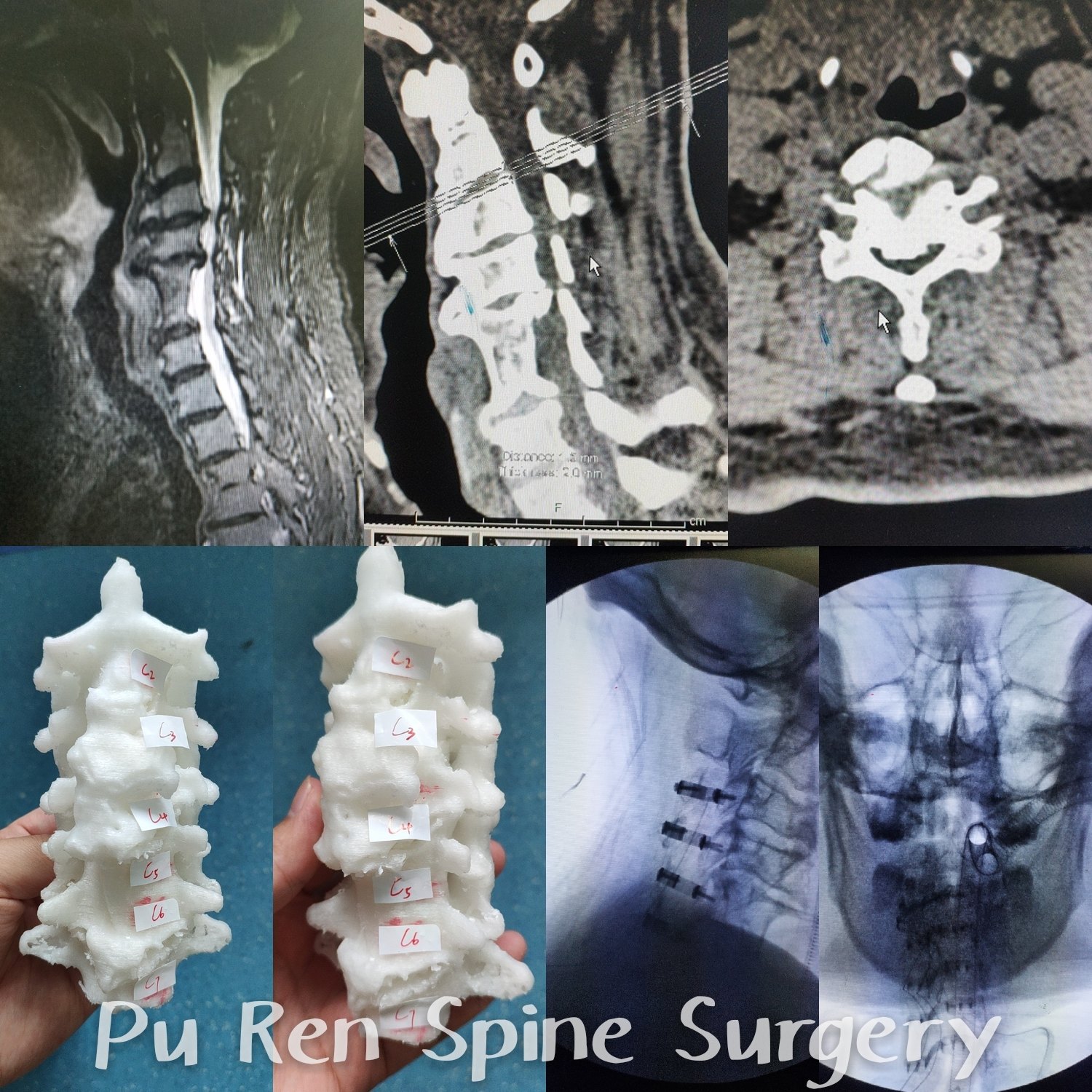 颈椎后路单开门椎管扩大成形术治疗脊髓型颈椎病 - 好大夫在线