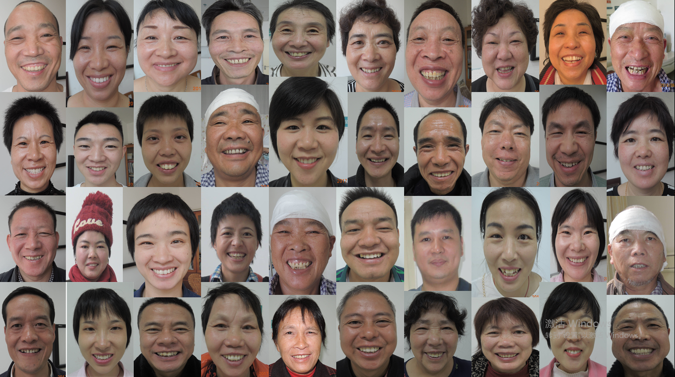 笑脸传承-听神经瘤术后患者 - 好大夫在线