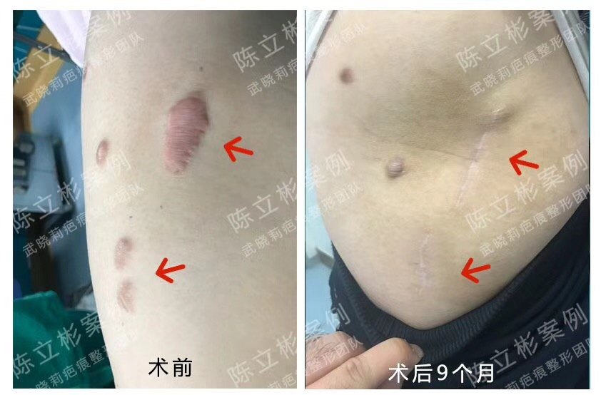 大腿增生性疤痕术后9月复诊 - 好大夫在线