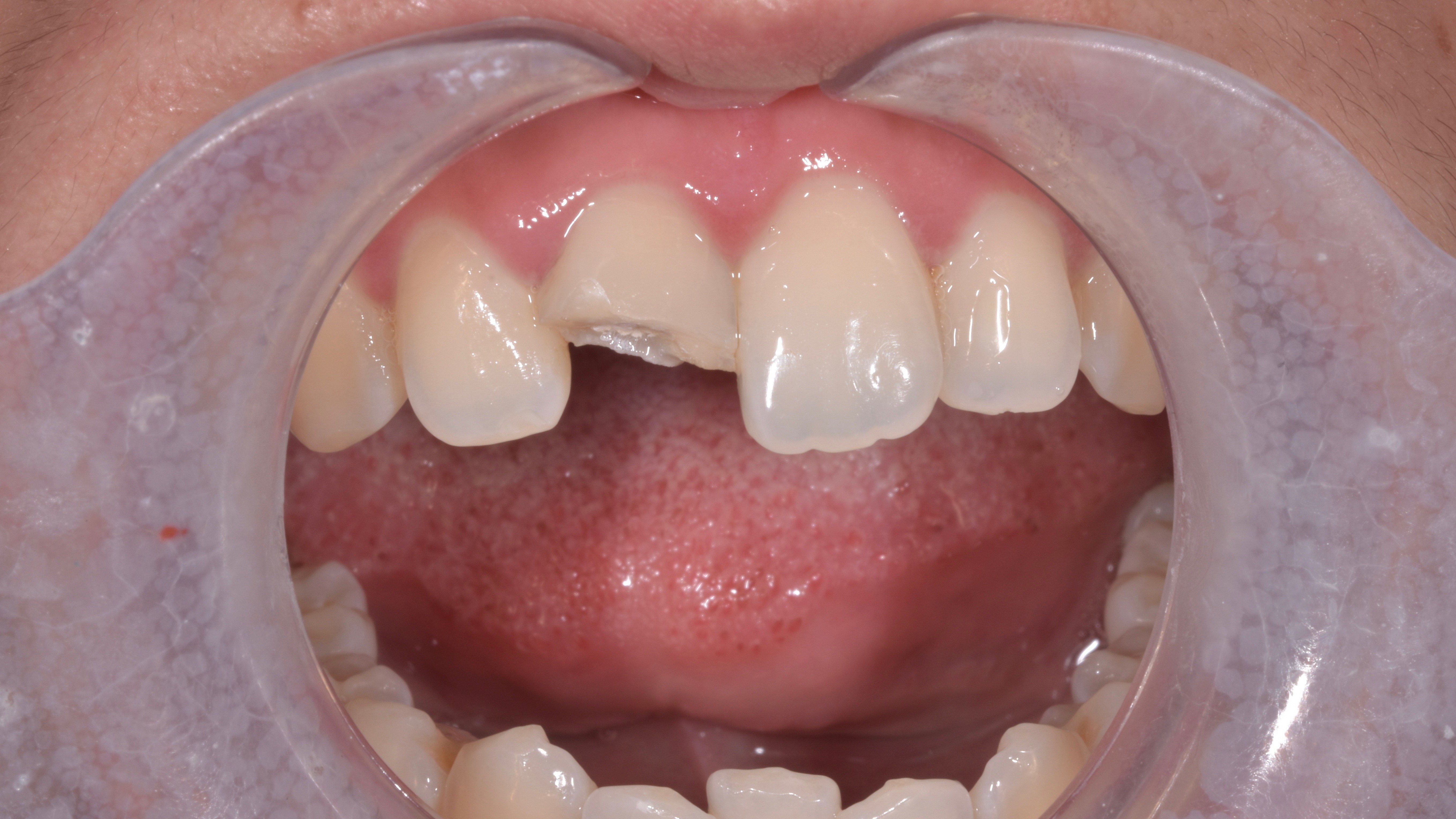 外伤牙齿修复后效果 - 好大夫在线