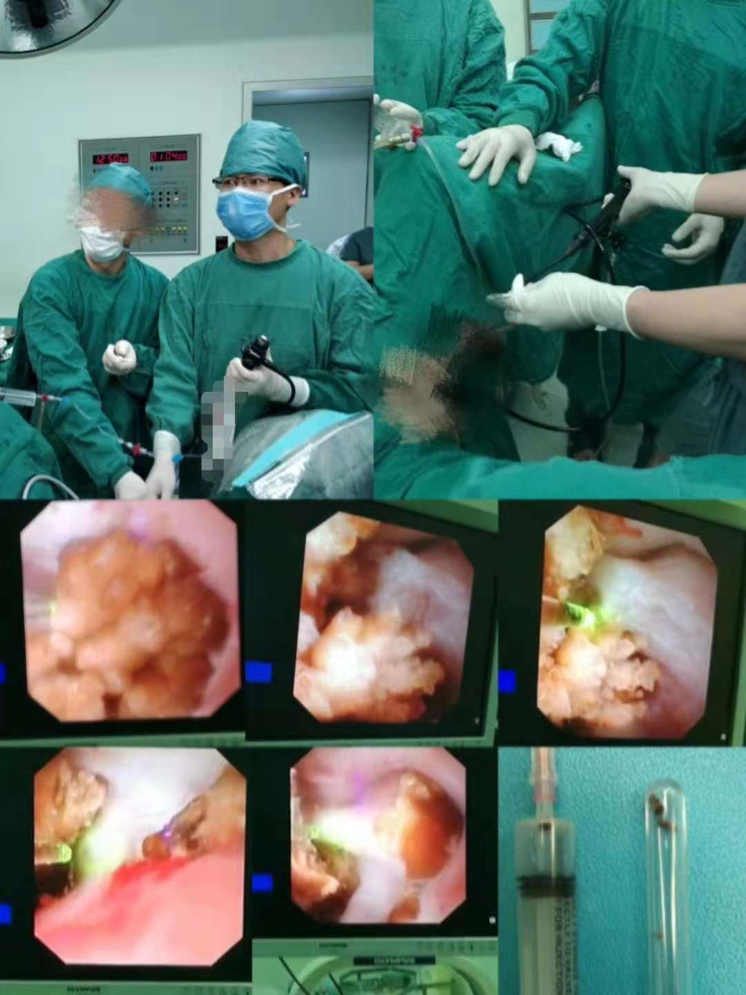 肾结石图片 激光手术图片