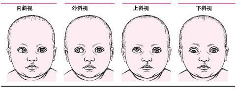 尤其是一种隐性斜视,外观无明显异常.