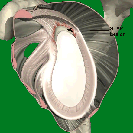 什么是肩关节镜?