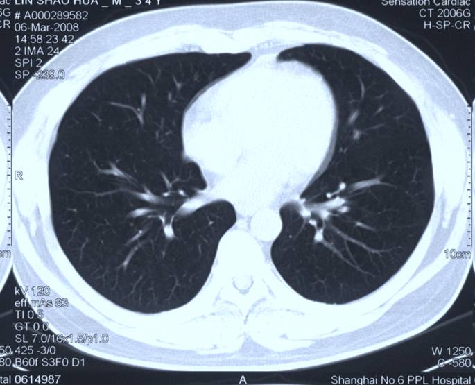 x線胸片或ct檢查陰性能排除甲狀腺癌肺轉移嗎