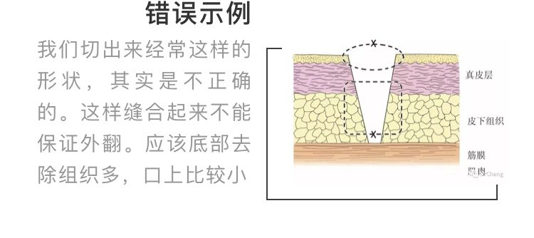 减张缝合原理图片