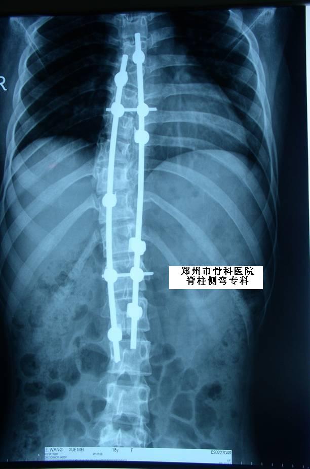 脊柱側彎專科典型病例一