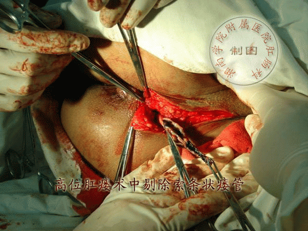 男性肛门手术图片