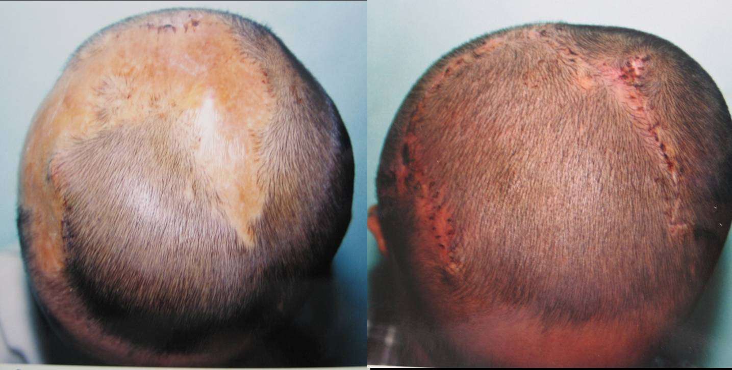 瘢痕性秃发 - 好大夫在线