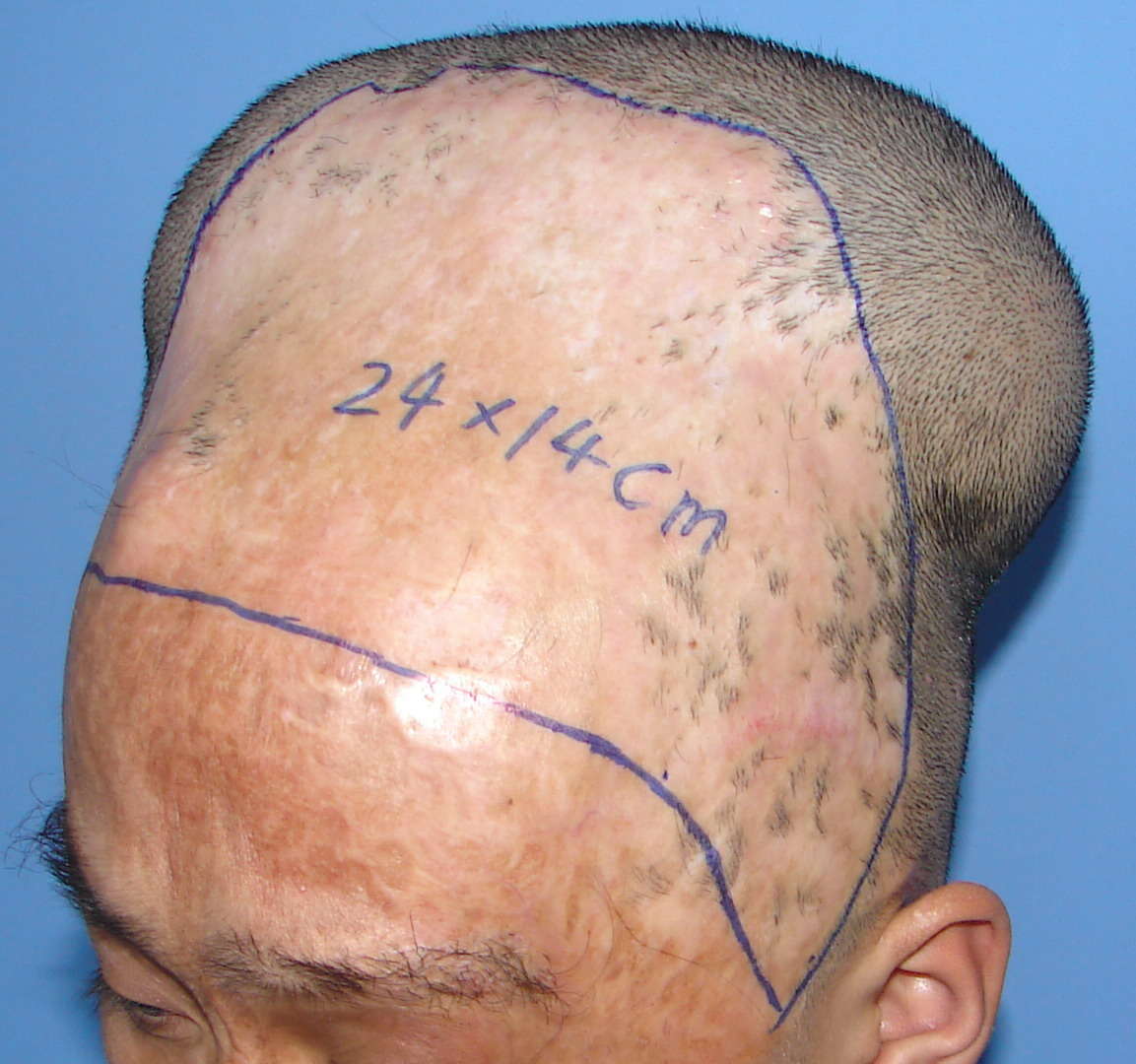 头皮扩张治疗头皮疤痕或秃发 - 好大夫在线