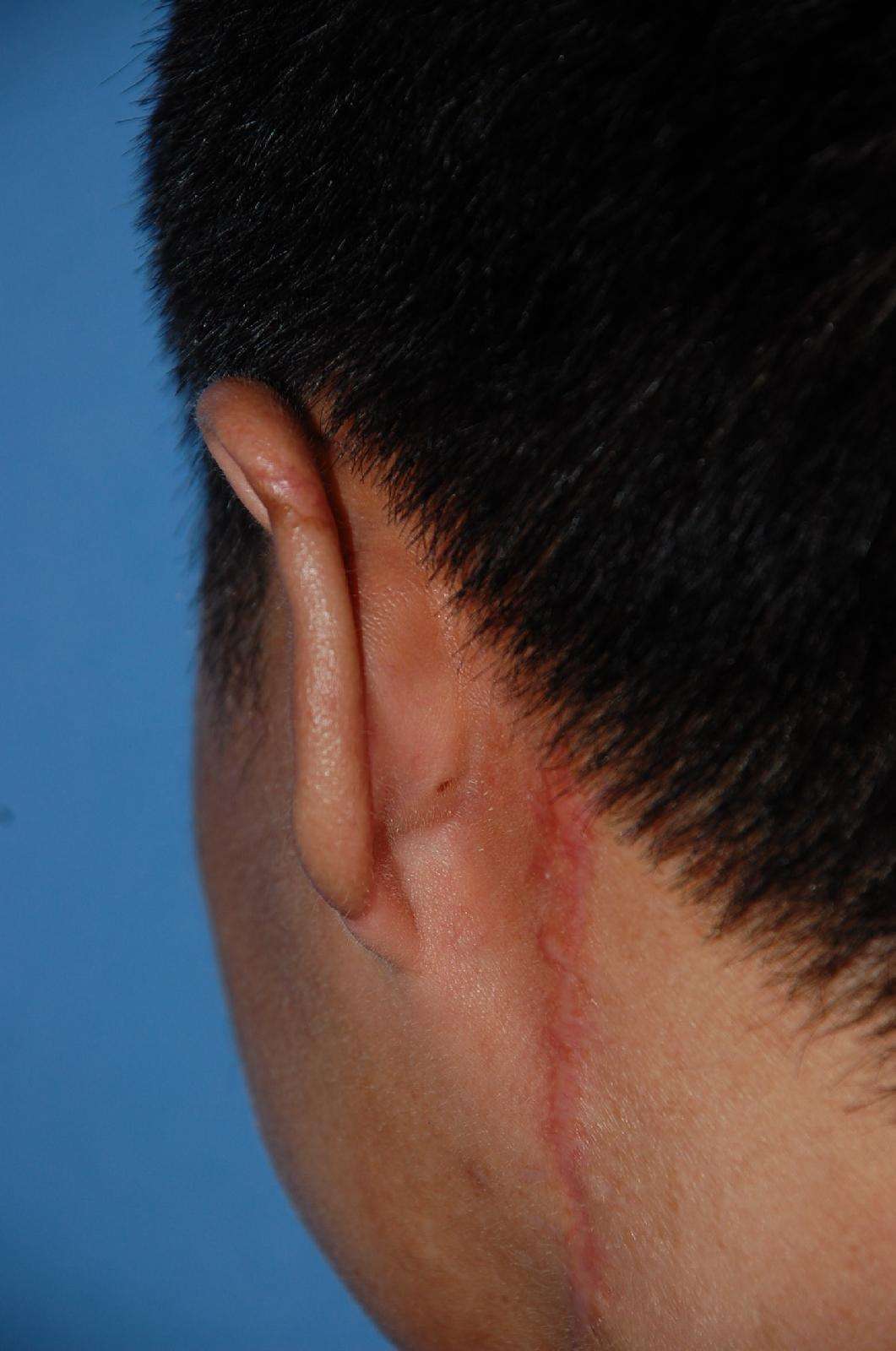 修补耳轮缺损 - 好大夫在线