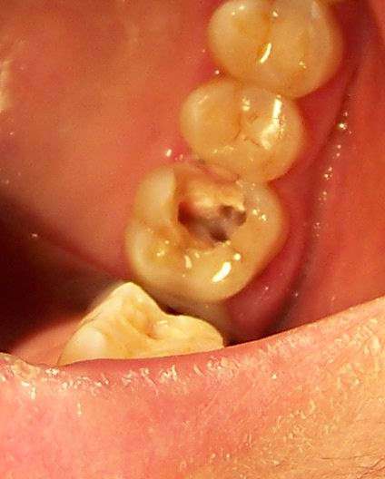 上颌第一磨牙在就诊时要注意 