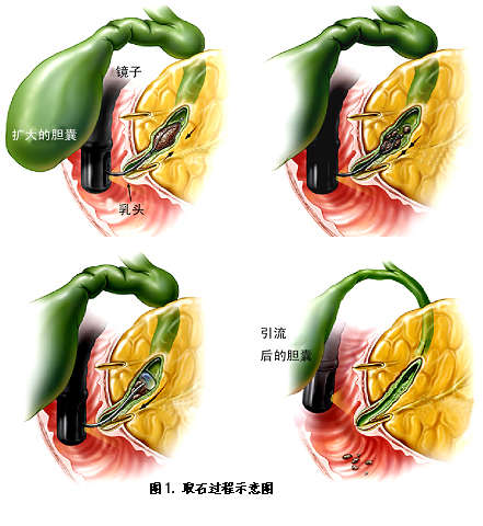 率在92%以上,當然,也有部分患者因耐受性和膽總管結構等多方面的原因