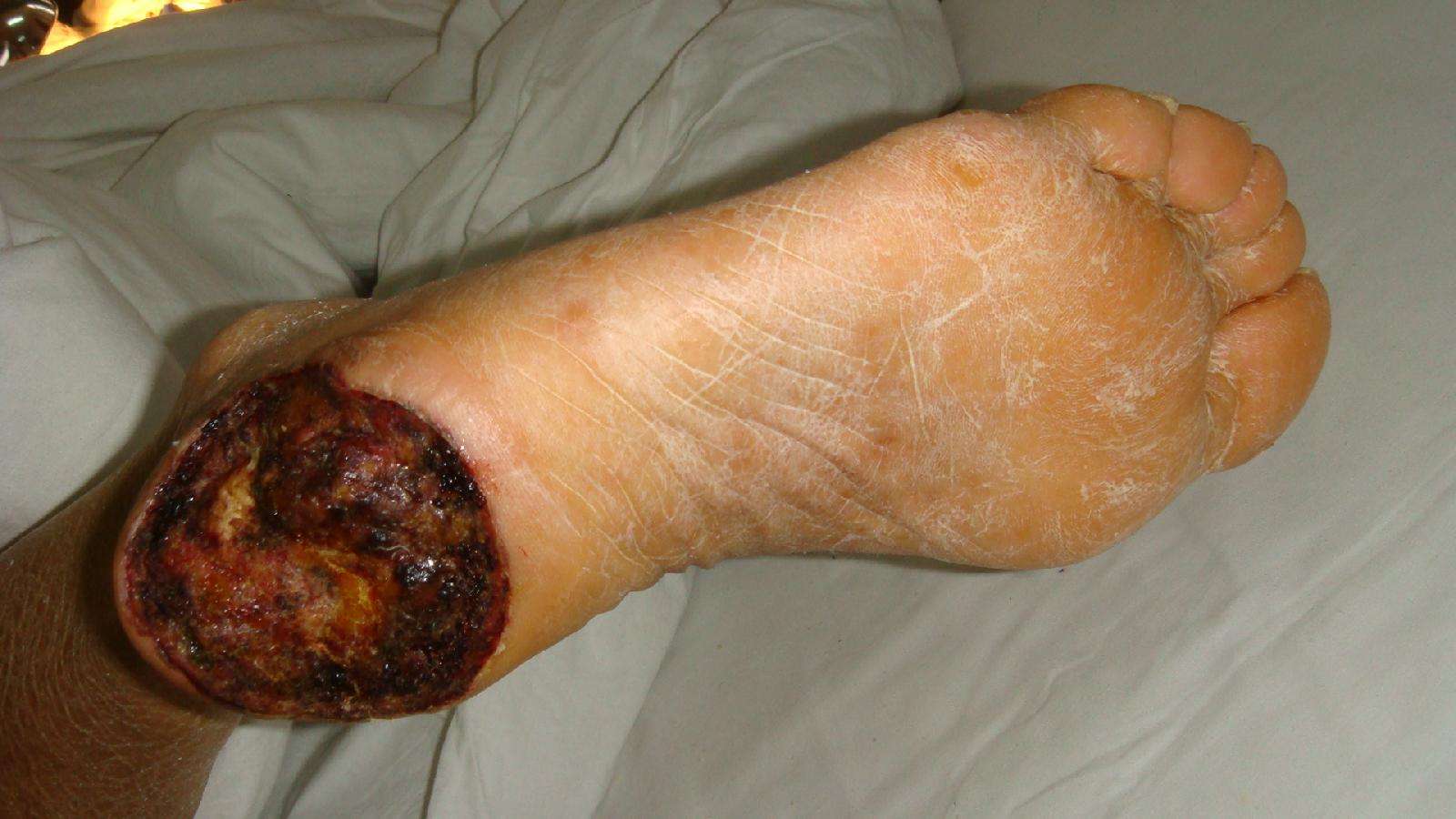 傅红医师近期手术的恶黑病例照片 - 好大夫在线