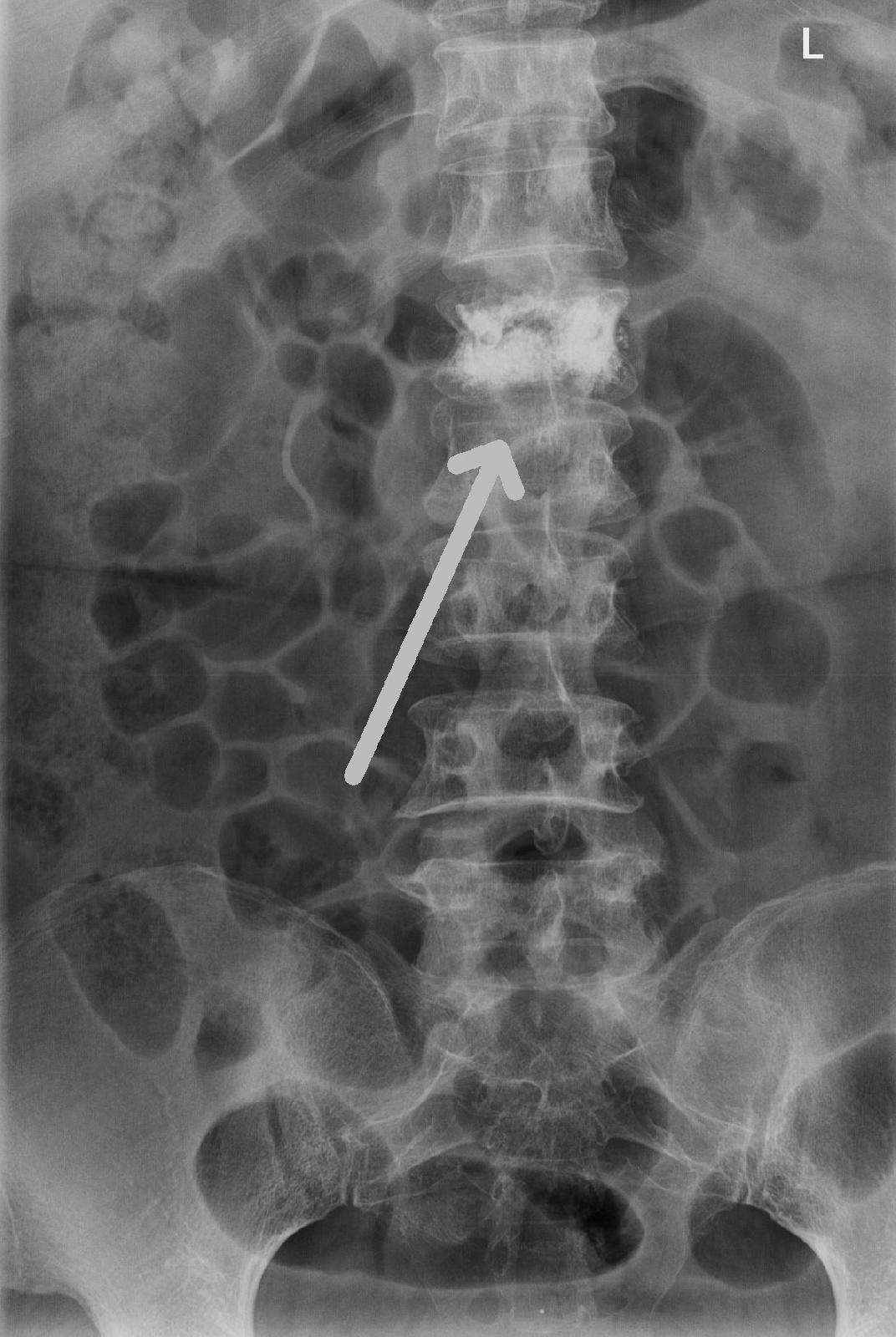 腰1椎体压缩性骨折行球囊扩张椎体成形术前,术后影像 - 好大夫在线