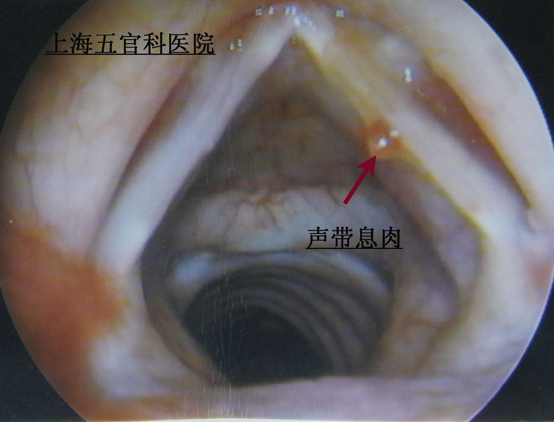 要手術治療的聲帶息肉圖片