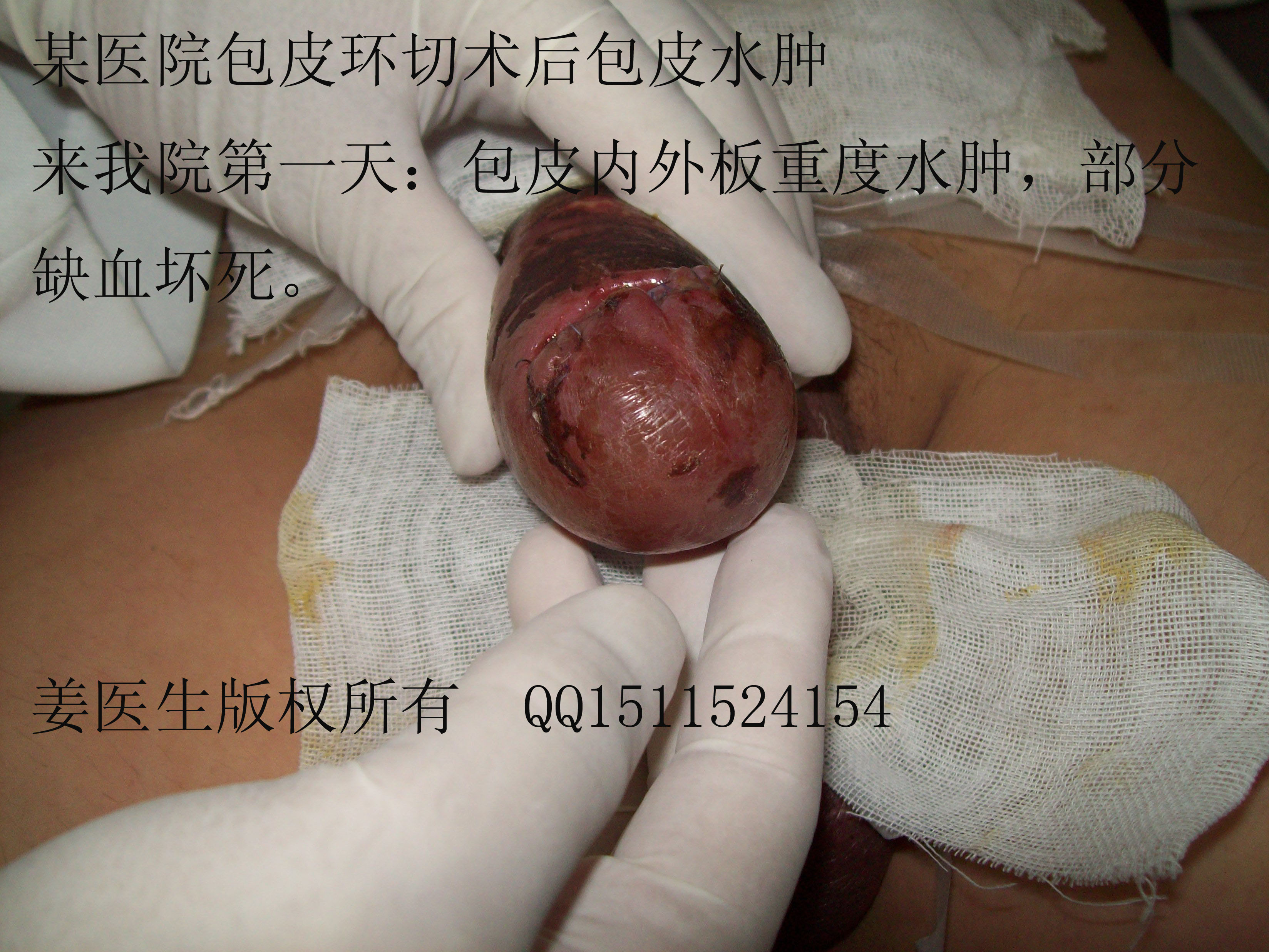 惨痛的教训(二):在某小医院做了"包皮环切术"后出现包皮重度坏死 - 好