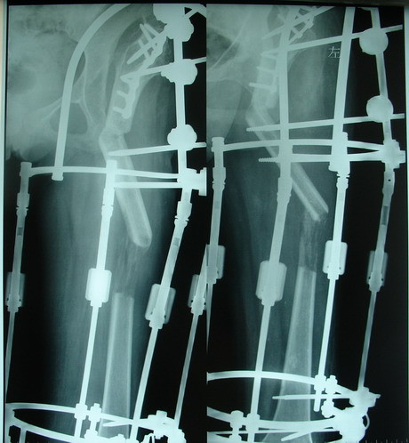 ilizarov髋部支撑截骨延长术
