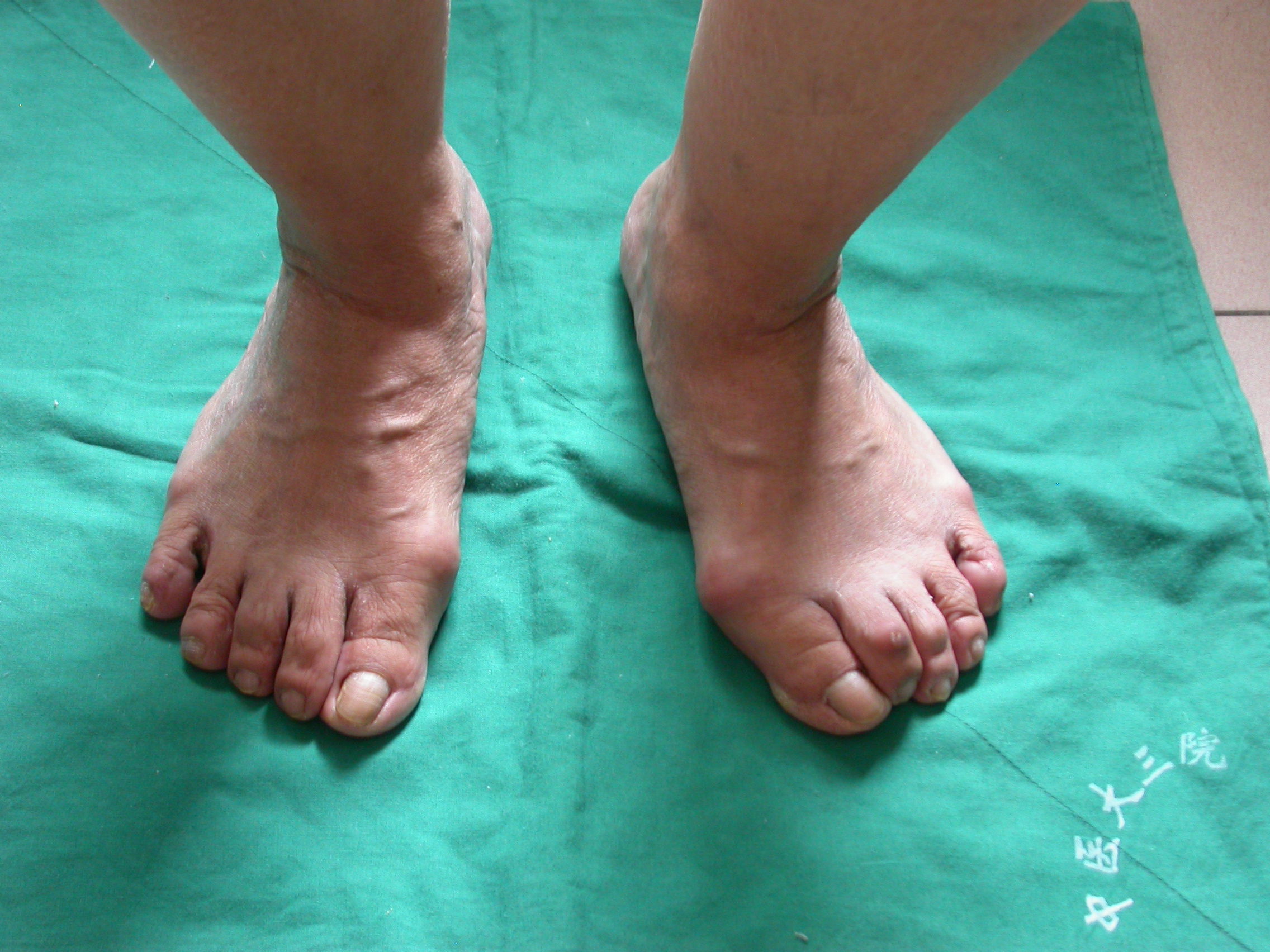 5月份刚做的一例拇外翻外观 - 好大夫在线