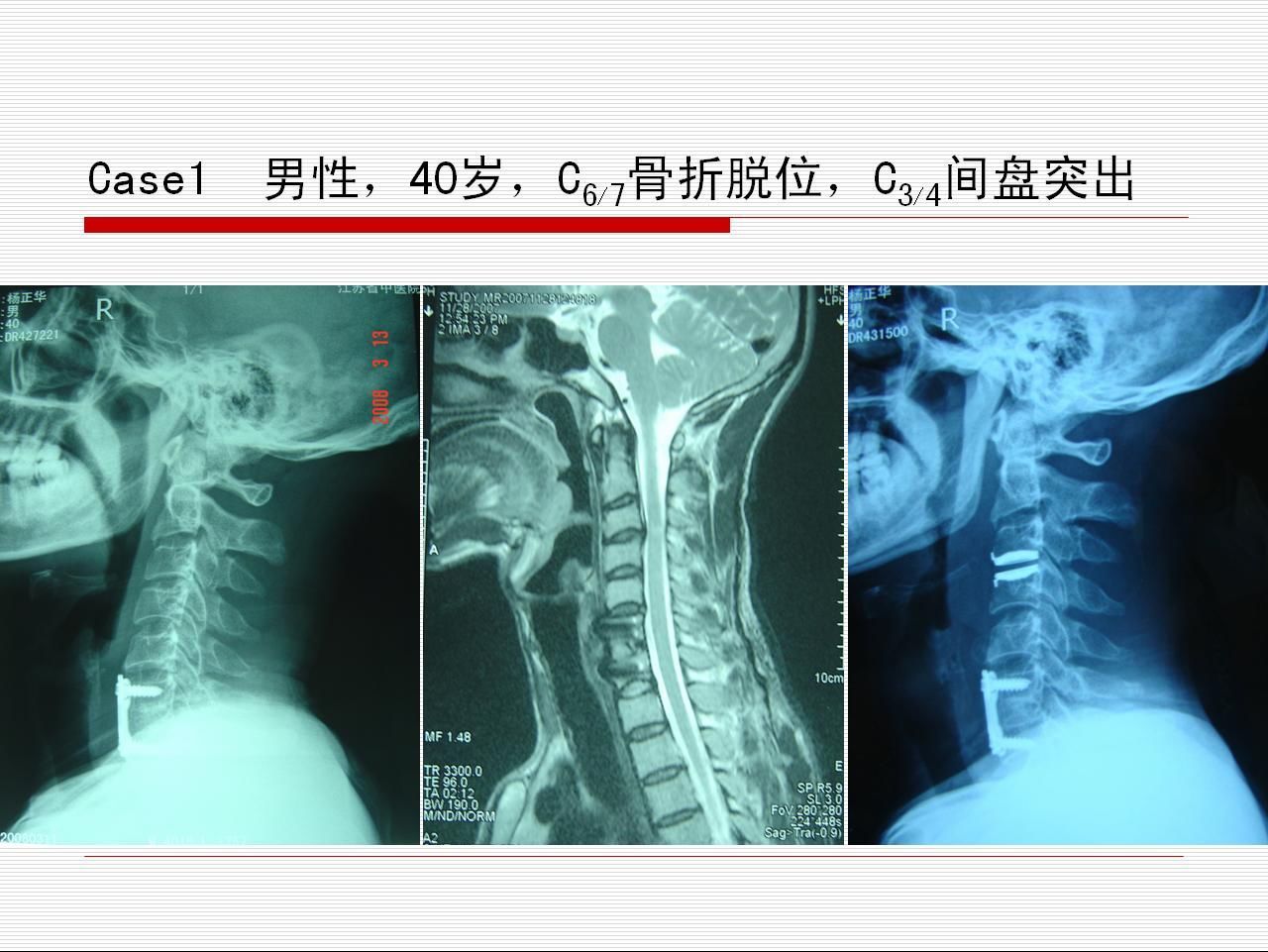 1964 年,fernstr02m 首先使用第一個人工頸椎間盤,其設計應用的目的