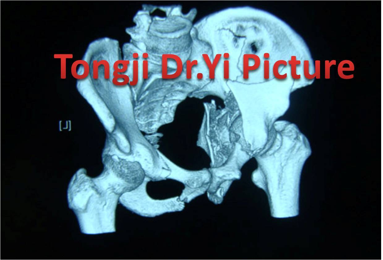 top8複雜雙柱髖臼骨折