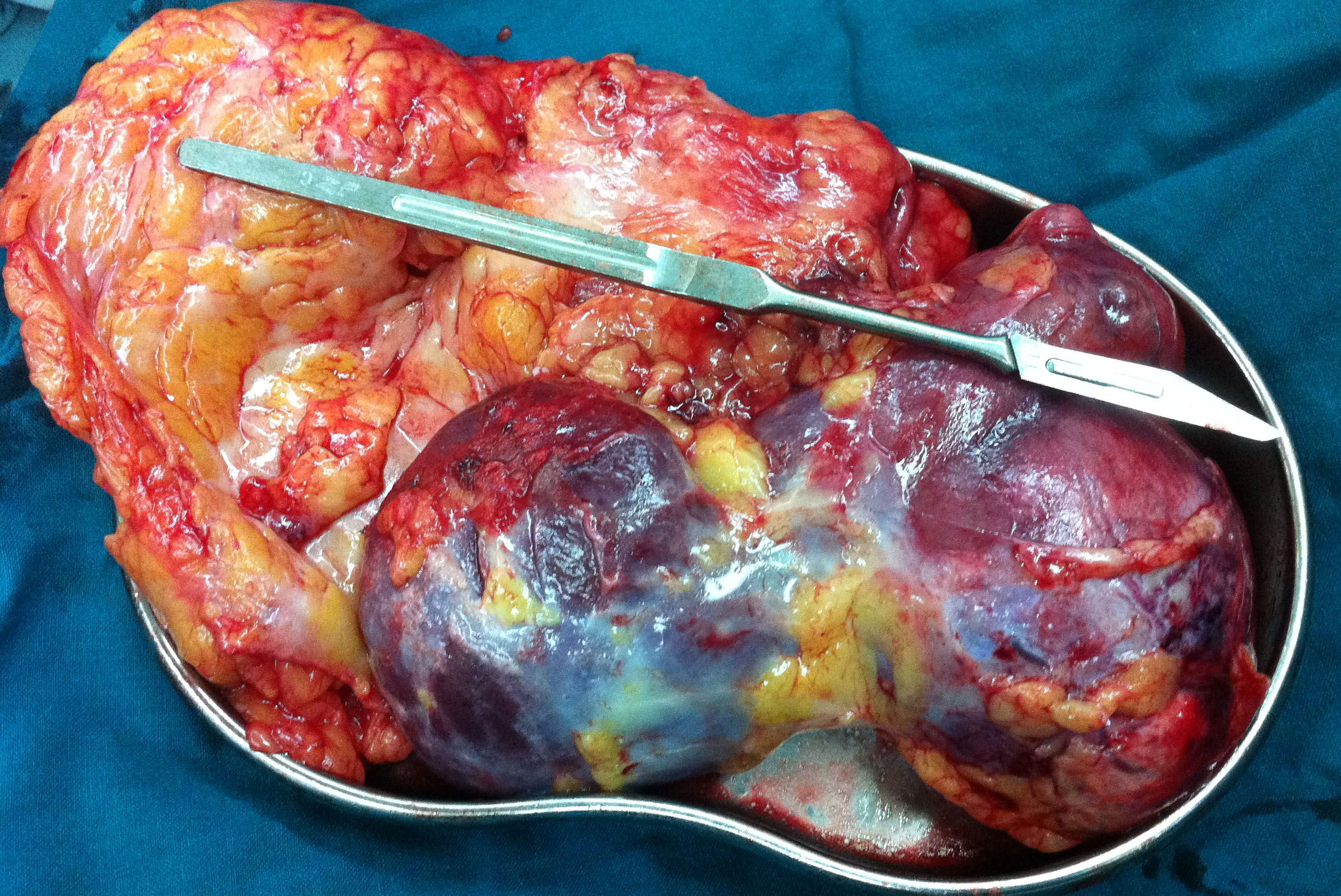 肾癌腹腔镜根治术,术中发现患者腰部空间小,手术困难大,改