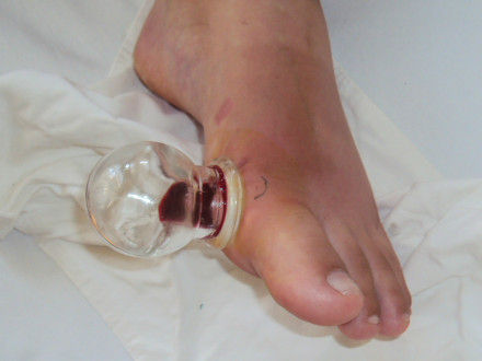 远离痛风从饮食做起转载