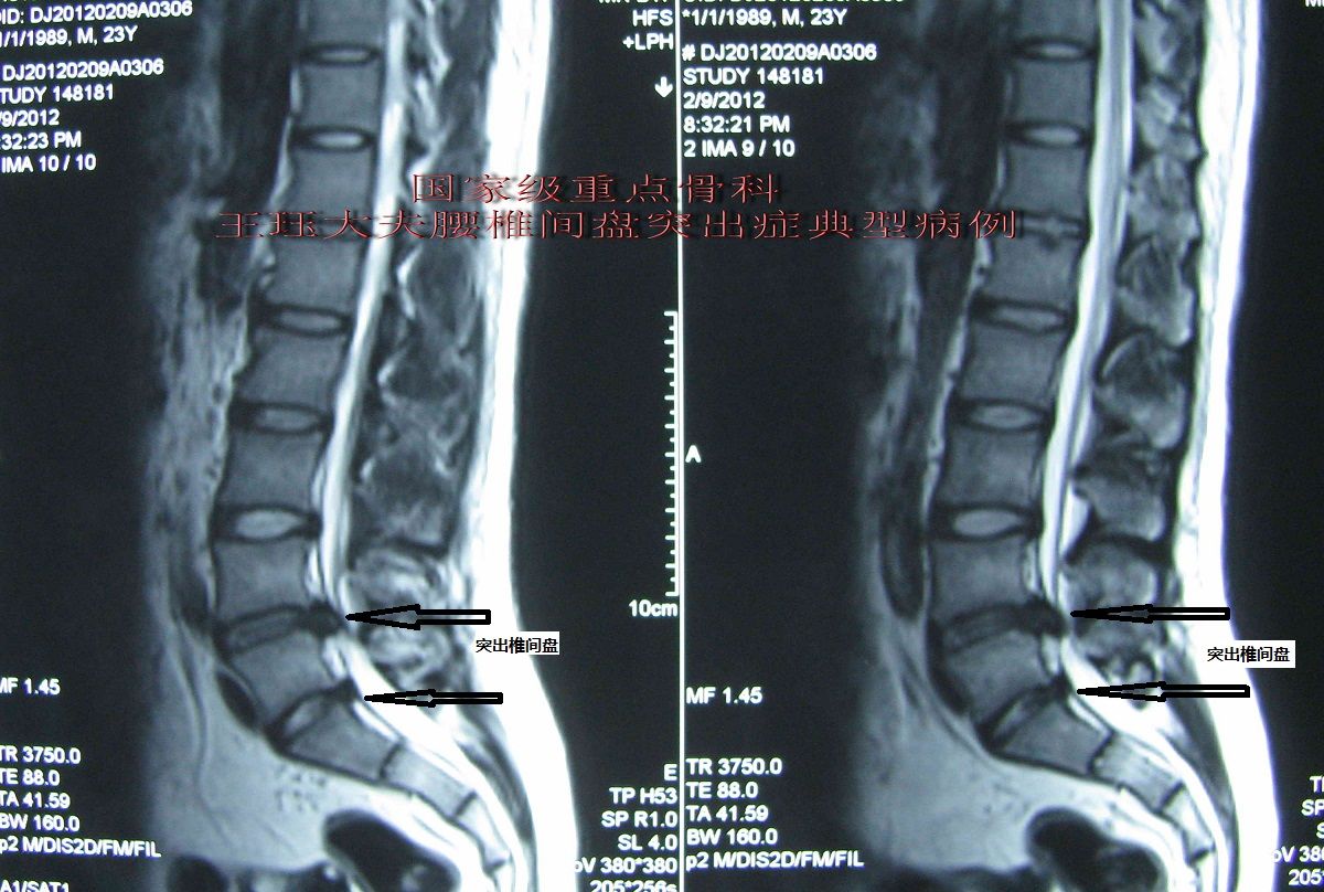 病例17:男,24岁,青年腰椎间盘突出症常见类型