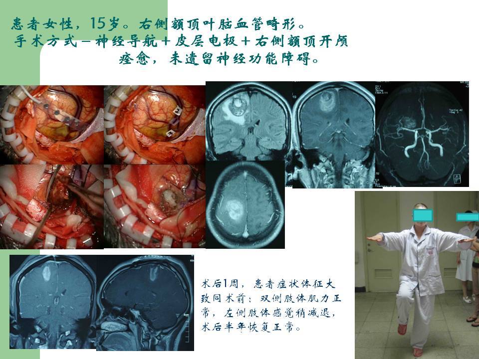 手術切除少女大腦中央溝腦血管畸形並保留神經功能