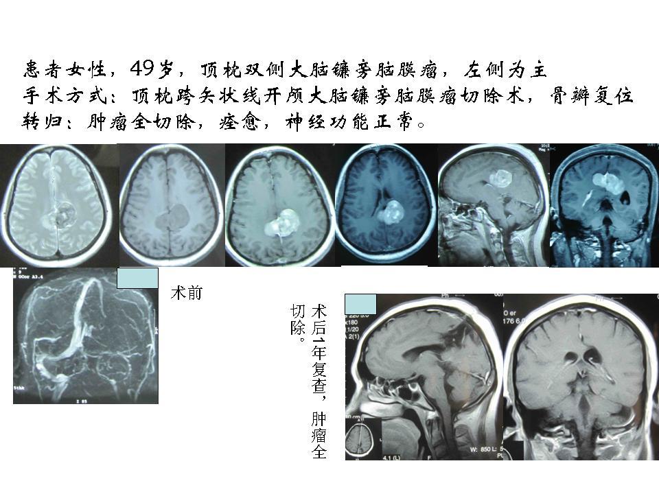 雙側大腦鐮旁腦膜瘤的手術治療