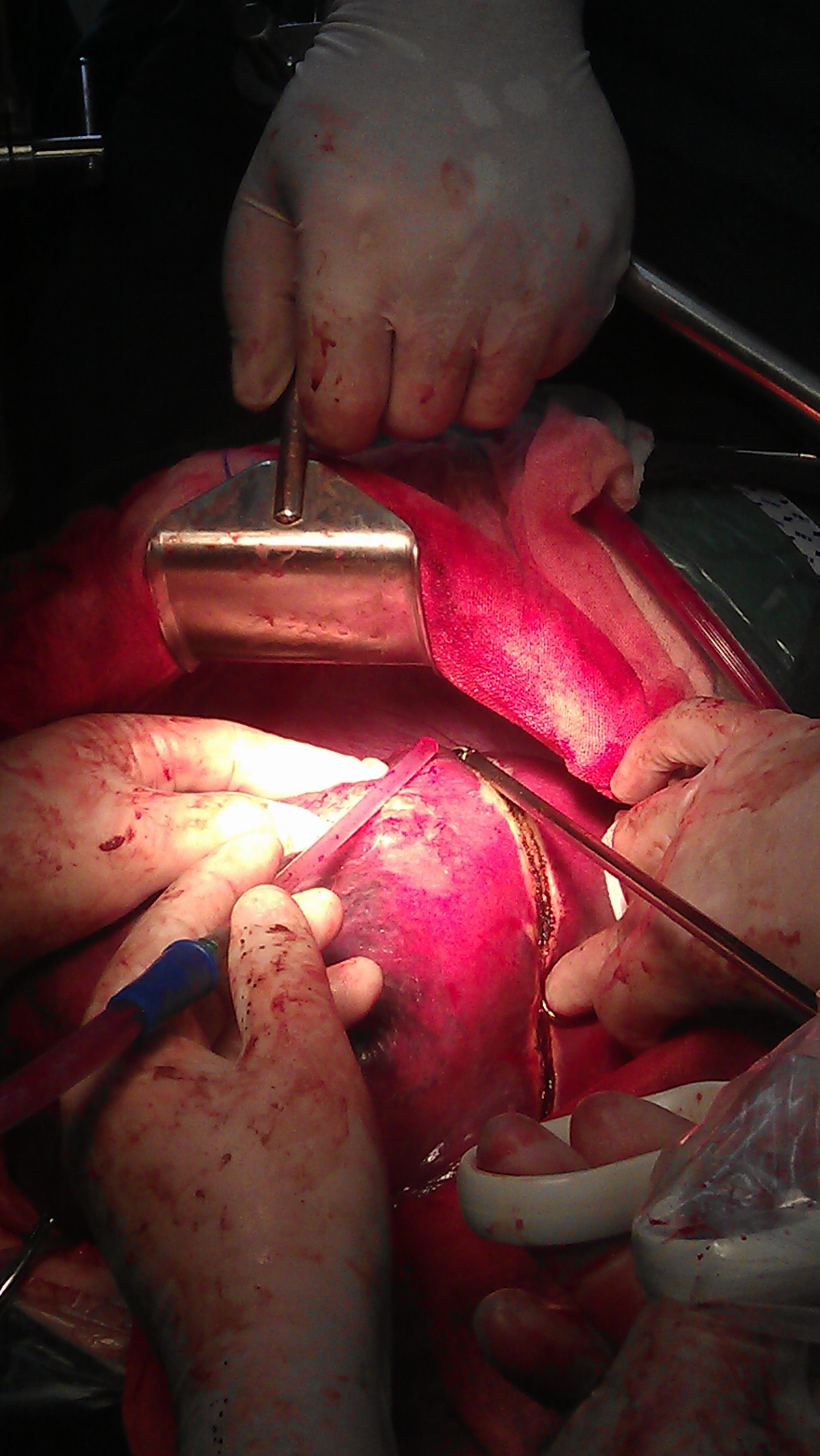 巨大肝癌的手术切除 - 好大夫在线