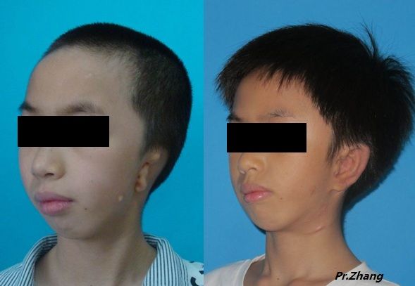 谈谈儿童第一二腮弓综合症的早期综合治疗问题