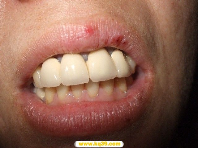 烤瓷牙失败的七宗罪 - 好大夫在线