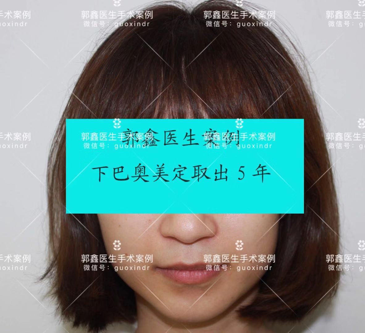 下巴奥美定术后5年1水印.jpg