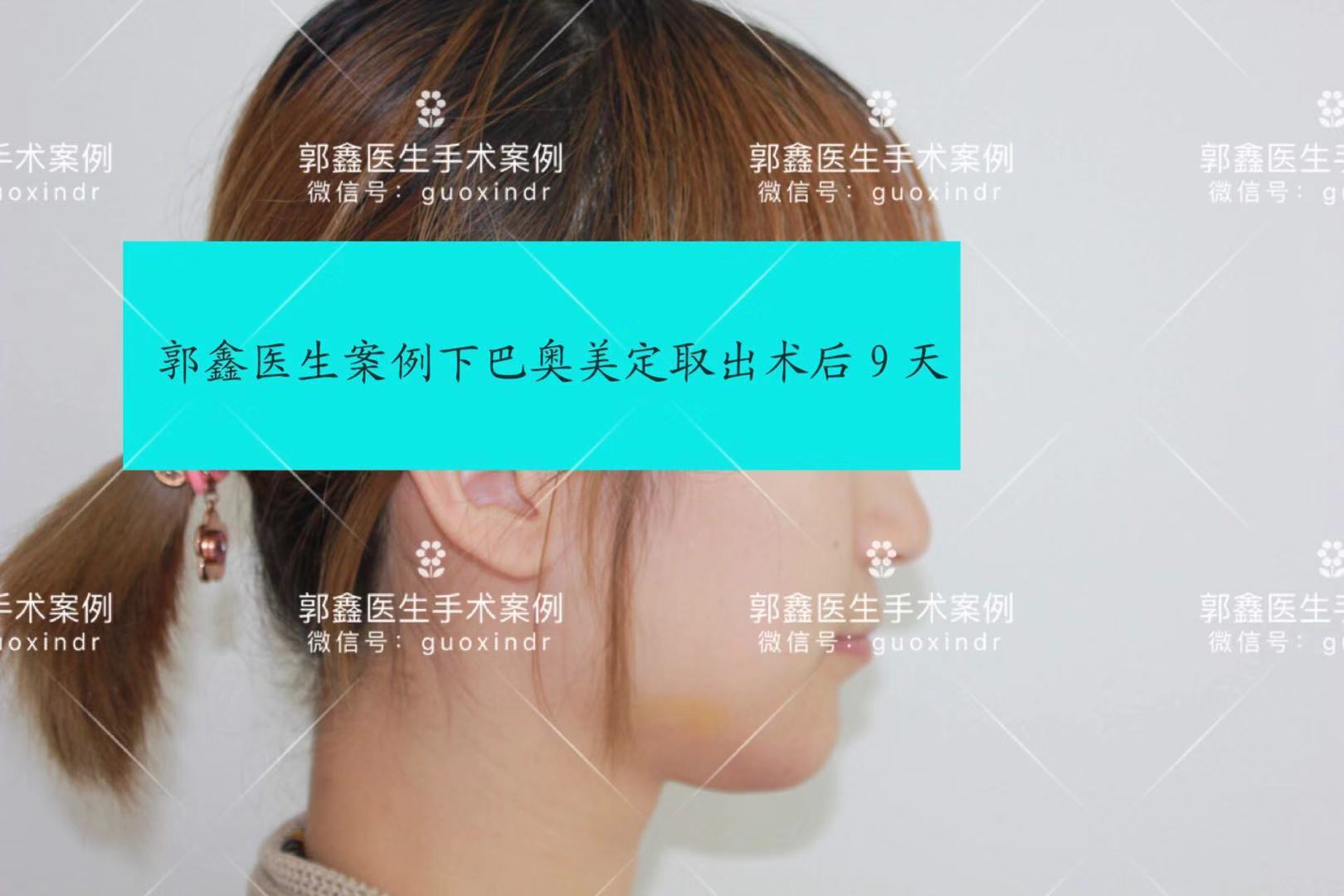 下巴奥美定术后9天2水印.jpg