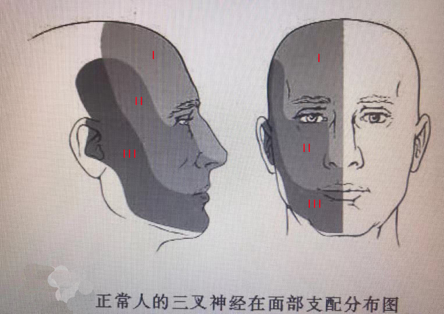 非典型面痛一種非三叉神經痛的面部疼痛