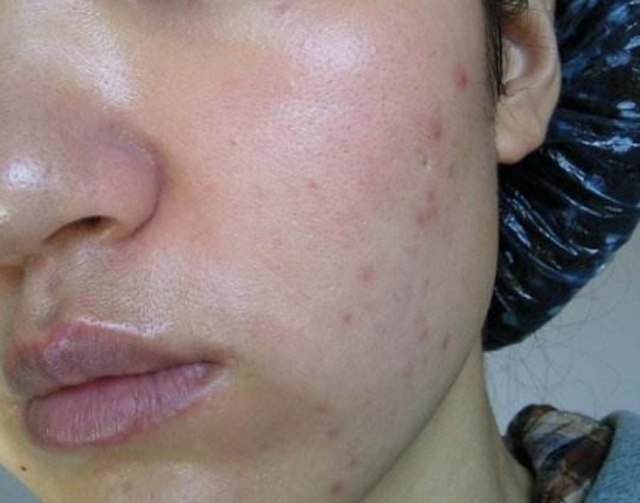 痘印凭什么有?由你自己决定! - 好大夫在线