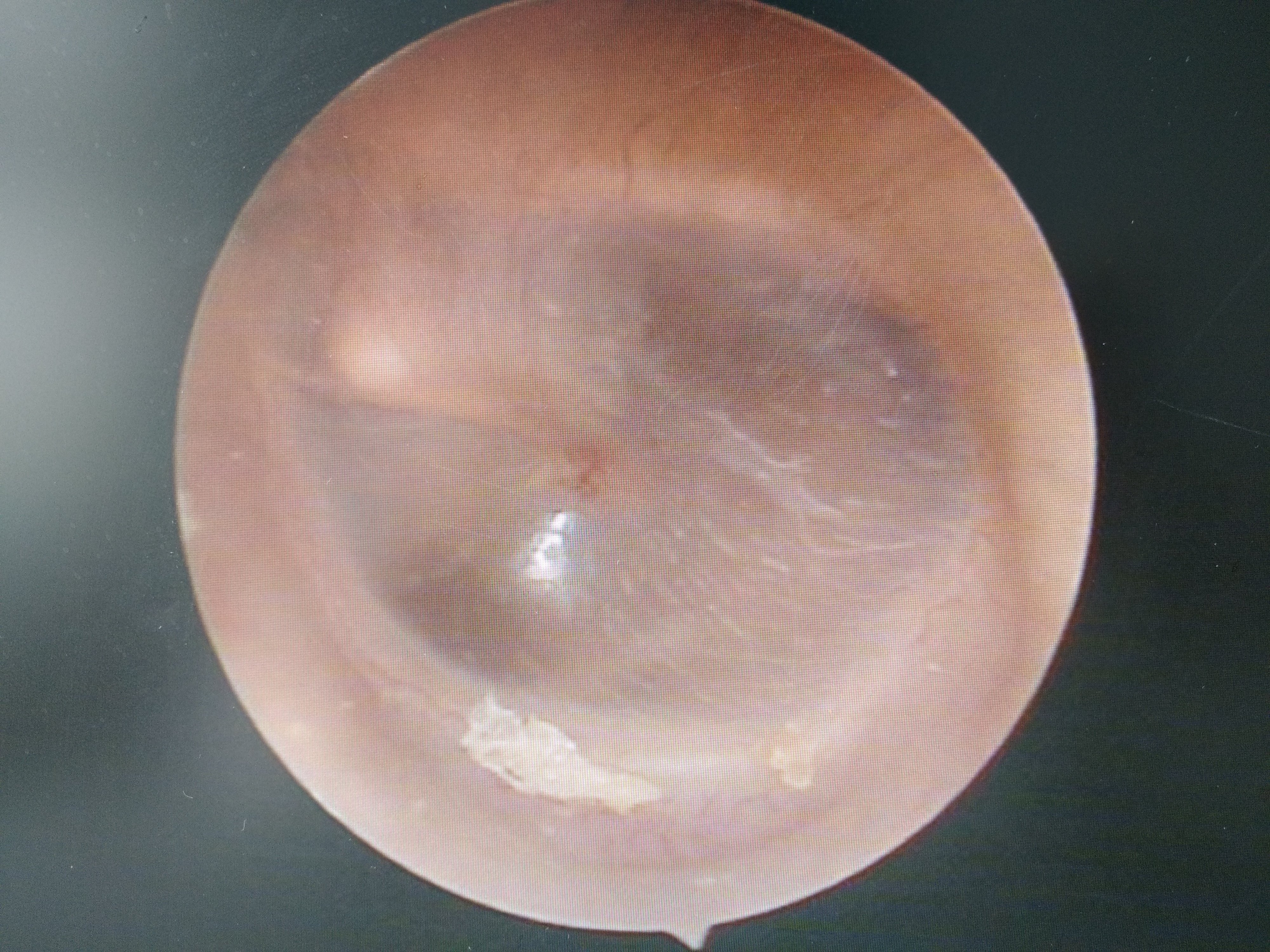 耳朵内部鼓膜正常图片图片