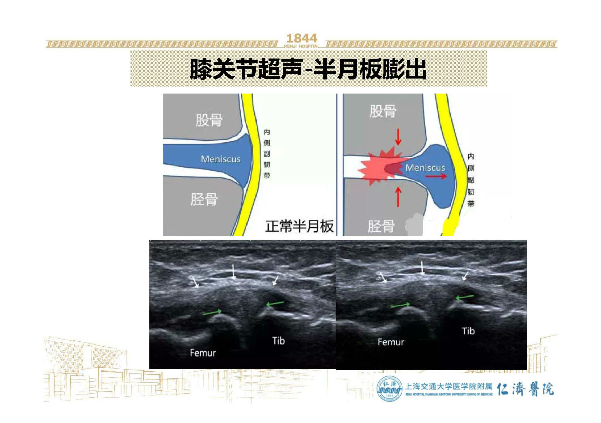 超声引导膝关节骨性关节炎治疗