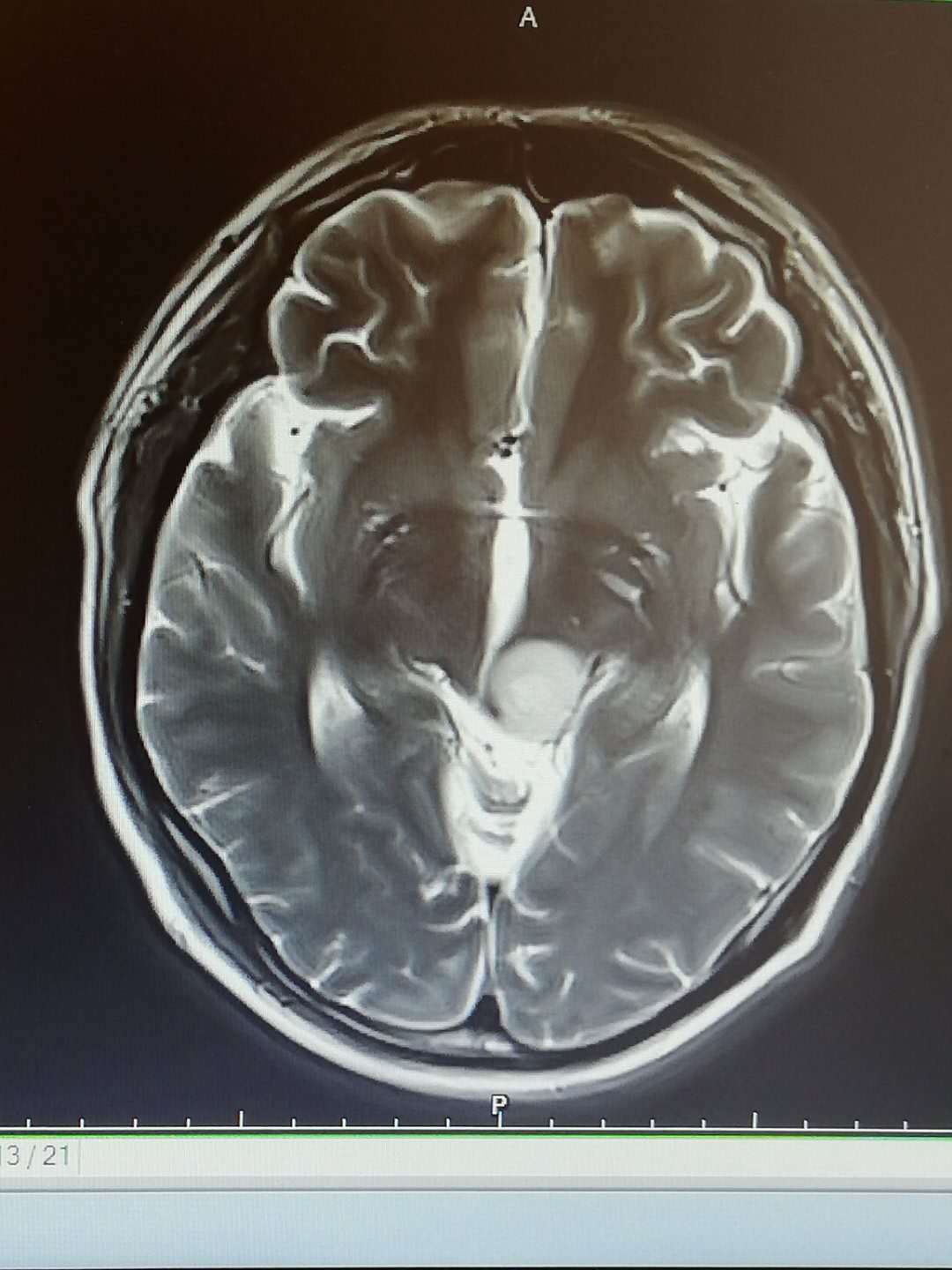 脑干胶质瘤的手术治疗 - 好大夫在线