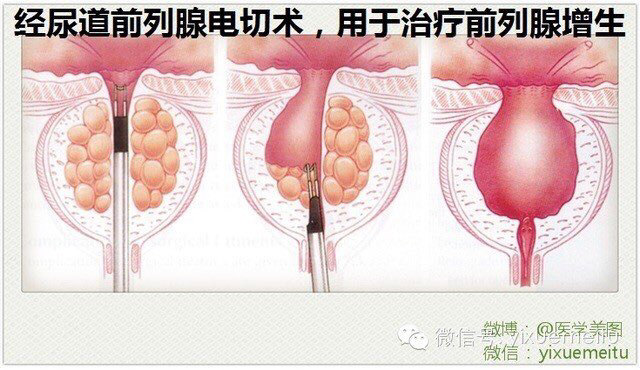 图解前列腺电切手术指征及方法