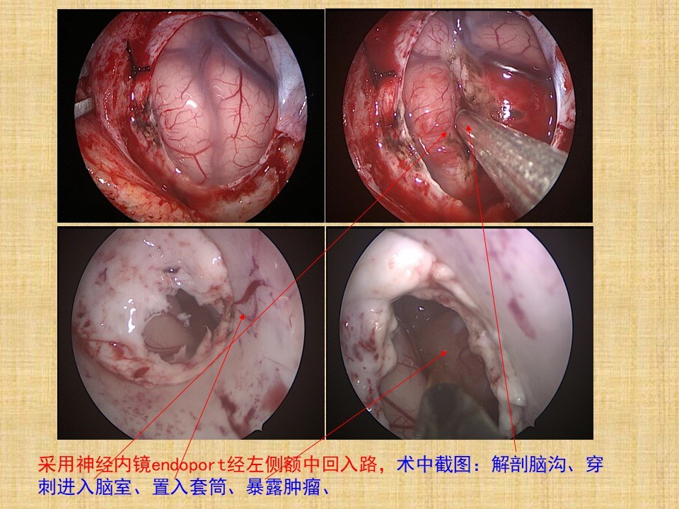 神经内镜经endoport技术切除5岁儿童侧脑室肿瘤1例 