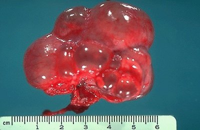 3,常染色体隐性遗传多囊肾(autosomal recessive polycystic kidney