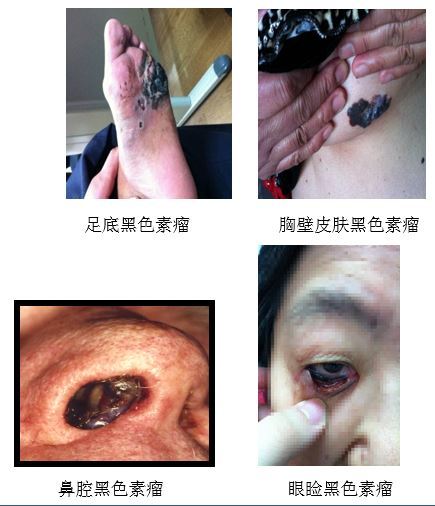 得了黑色素瘤怎么办?