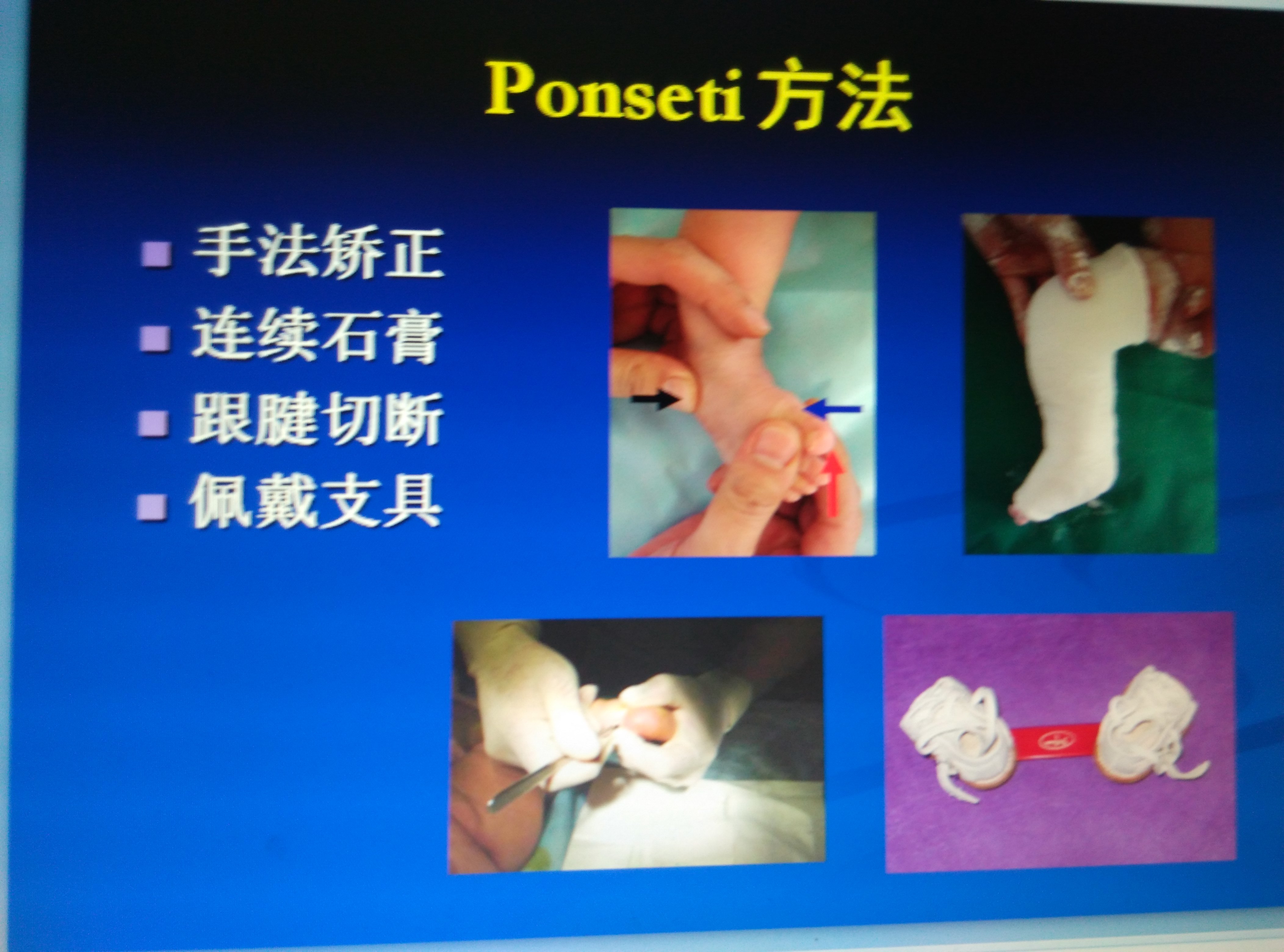 ponseti石膏矫形术图片